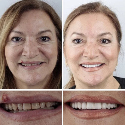 🏆 2026 Top Rated⏰Owiwell™ Medical Full Denture with Strong Suctiond