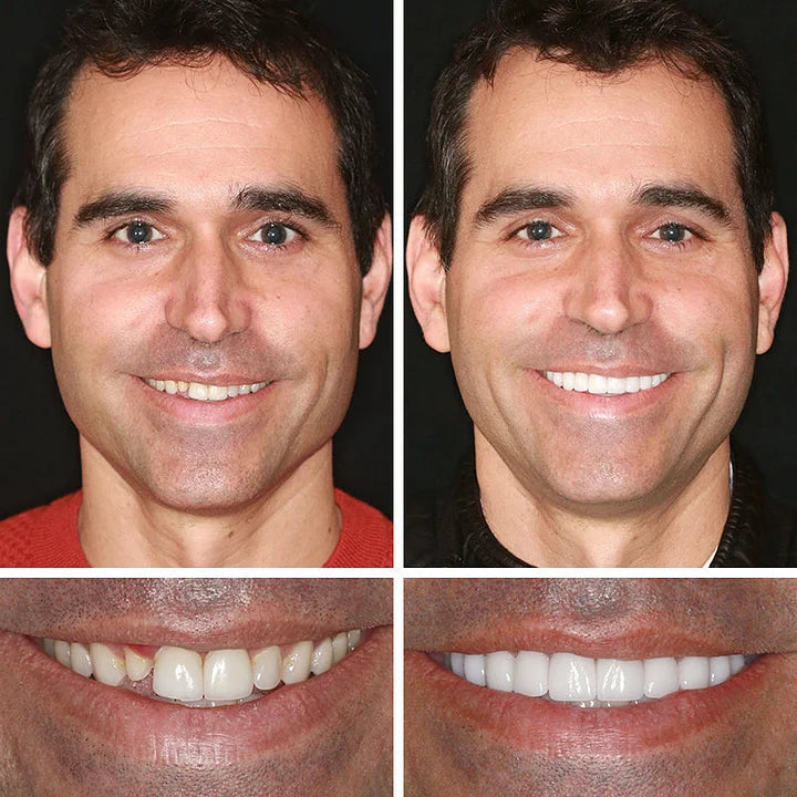 🏆 2026 Top Rated⏰Owiwell™ Medical Full Denture with Strong Suctiond